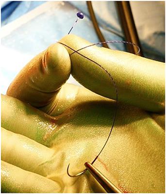 Transanal Hemorrhoidal Dearterialization (THD) Anolift-Prospective Assessment of Safety and Efficacy